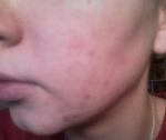 Тональный крем для проблемной кожи CLINIQUE Anti-Blemish Solutions Liquid Makeup фото
