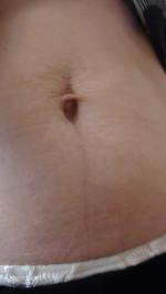 Радиоволновый лифтинг фото