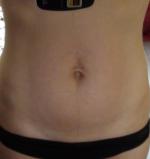 Радиоволновый лифтинг фото