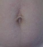 Радиоволновый лифтинг фото