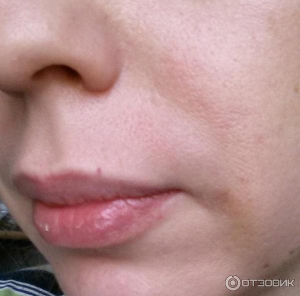 Коррекция морщин носогубных складок Juvederm Ultra 4 фото