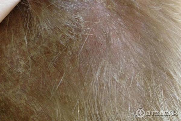 Себорея кожи головы. Причины, симптомы, диагностика и лечение себореи волос