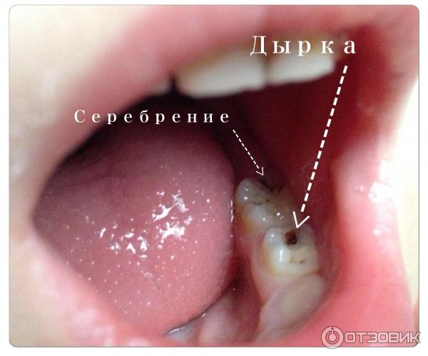 Почему чернеют молочные зубы у ребенка?