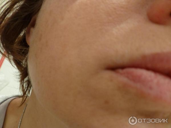 Коррекция морщин носогубных складок Juvederm Ultra 4 фото