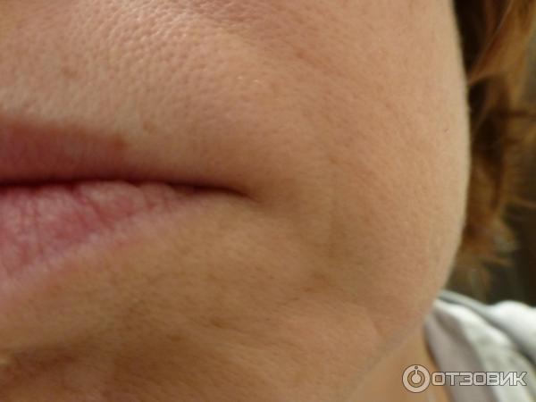 Коррекция морщин носогубных складок Juvederm Ultra 4 фото