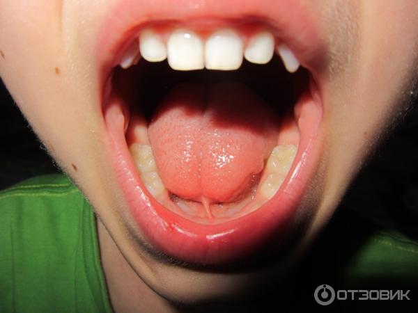 Короткая уздечка верхней губы: диагностика и коррекция