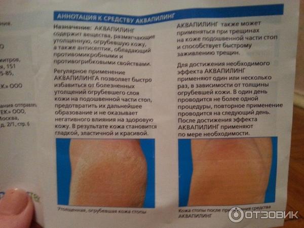 Аквапилинг крем для ног инструкция по применению. Аквапилинг. Аквапилинг для лица до и после. Аквапилинг состав раствора. Аквапилинг для ног инструкция по применению.