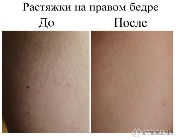 Resolady отзывы до и после Отзыв о Крем для кожи БороФреш "Ластик" Закупать его надо партиями, чтобы увидет